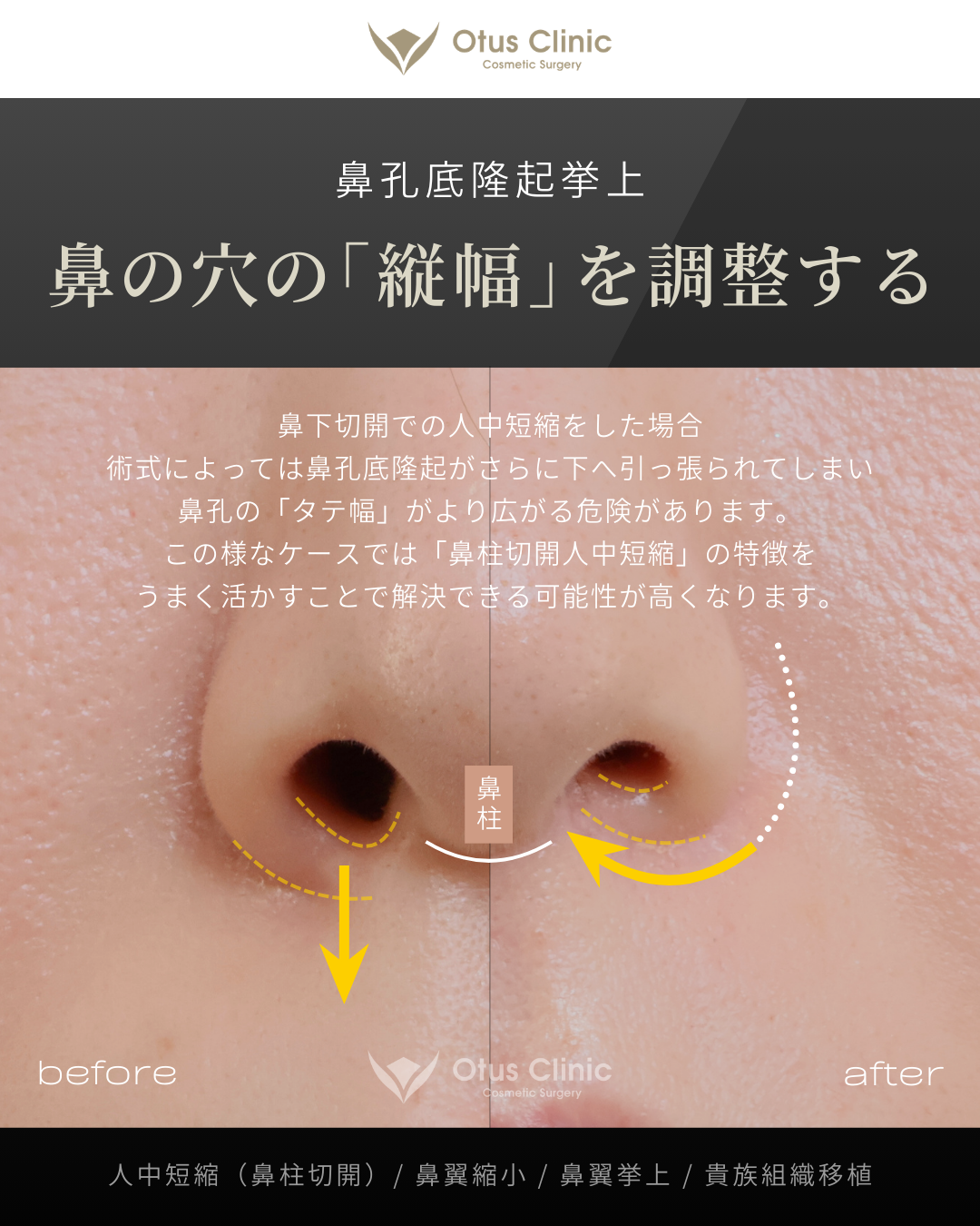 鼻柱切開人中短縮・鼻翼縮小・鼻翼挙上・貴族組織移植