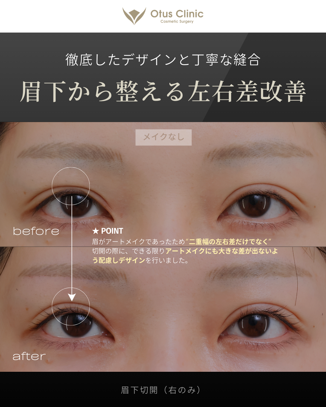 眉下切開（右のみ）