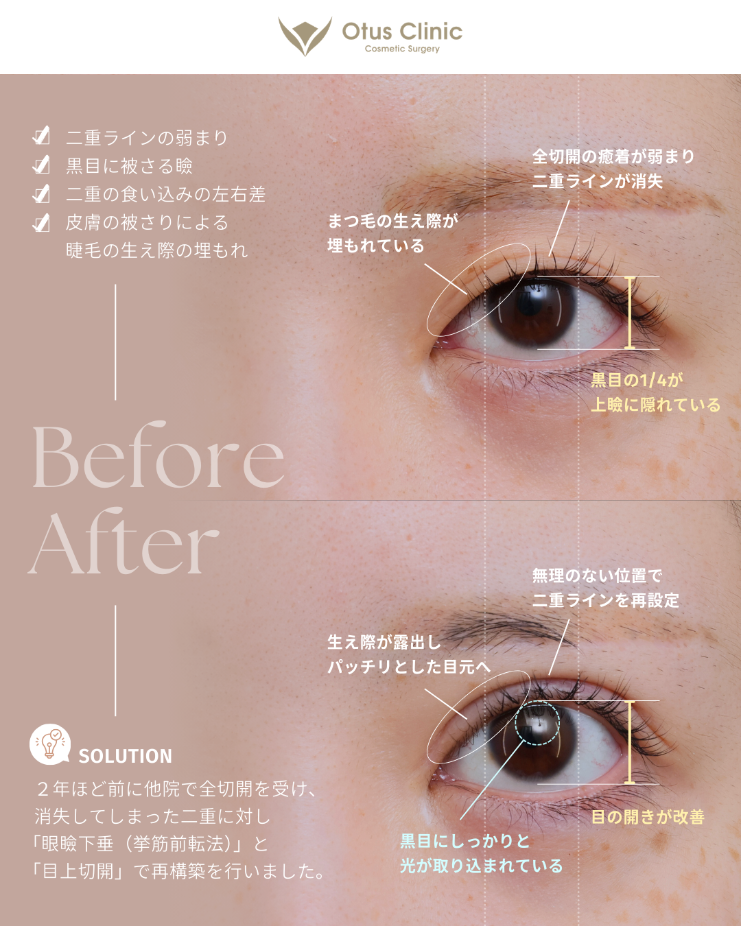 眼瞼下垂（挙筋前転法）・目上切開