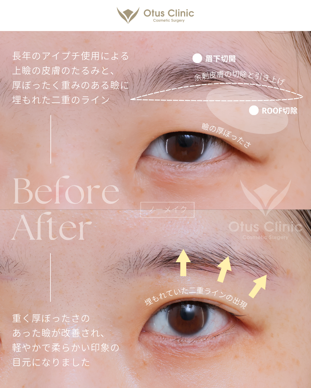 眉下切開・ROOF切除