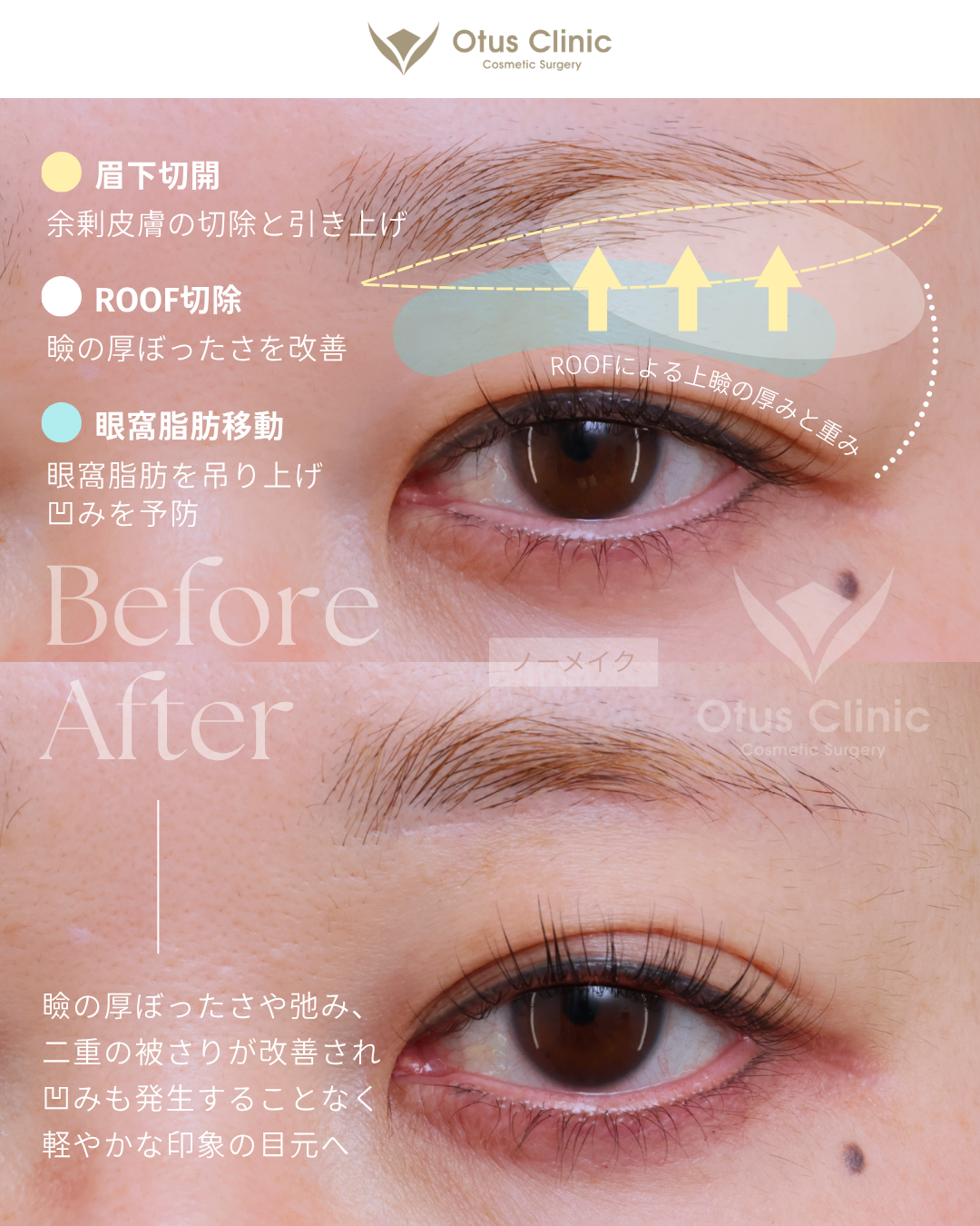 眉下切開・ROOF切除・眼窩脂肪移動