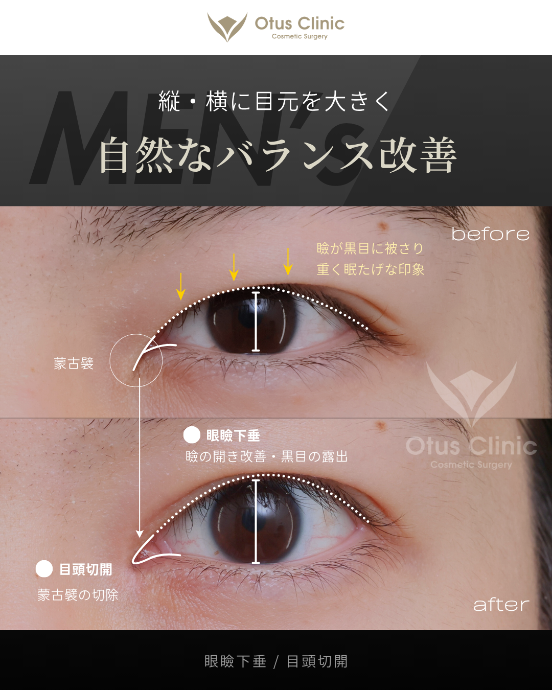 眼瞼下垂・目頭切開