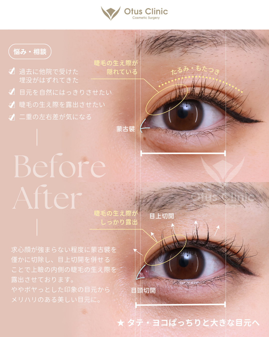 目上切開・目頭切開