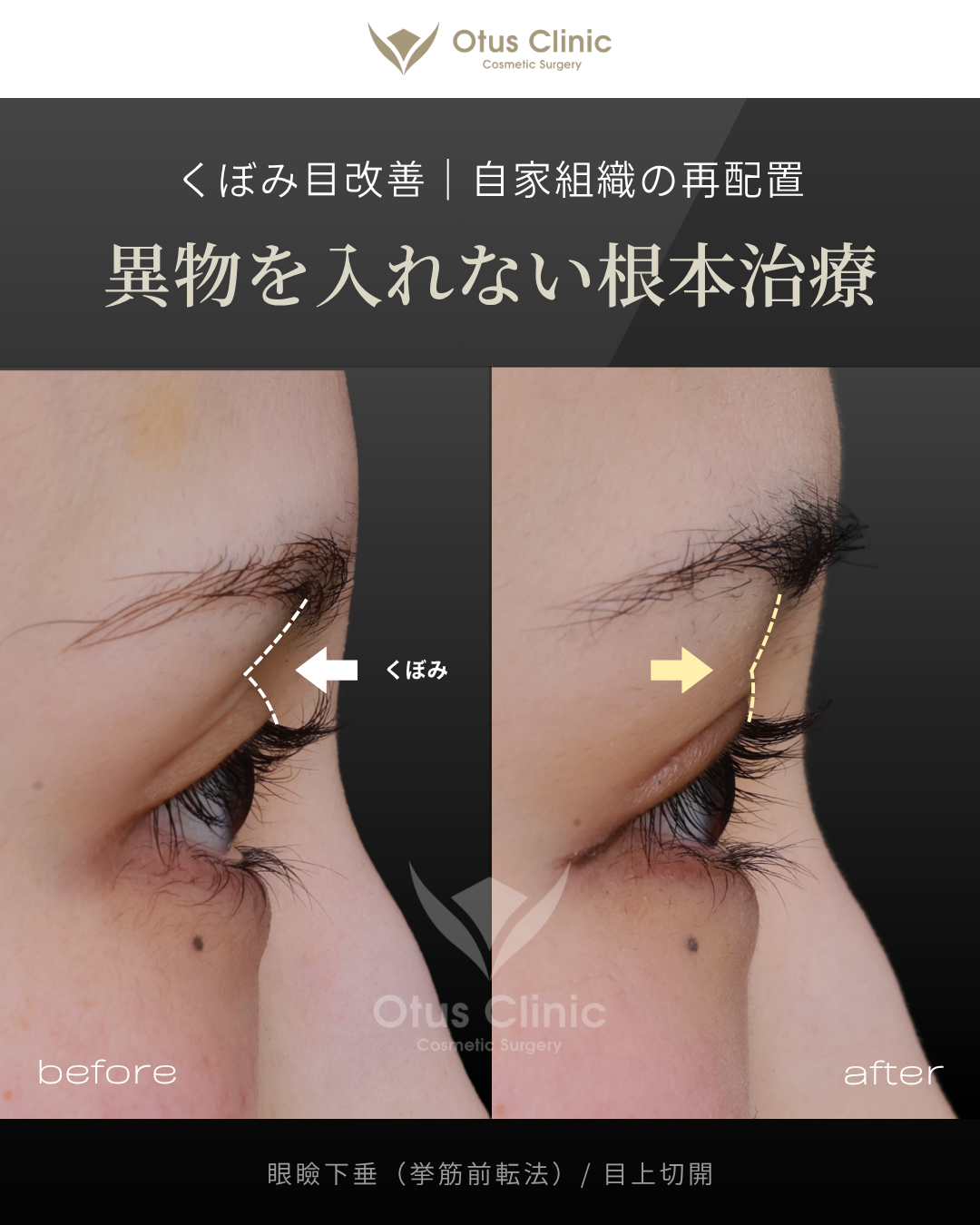 眼瞼下垂（挙筋前転法）・目上切開