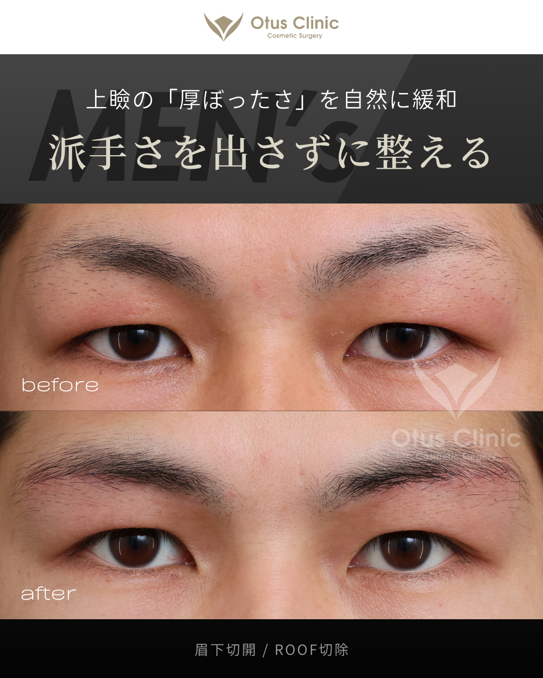 眉下切開・ROOF切除