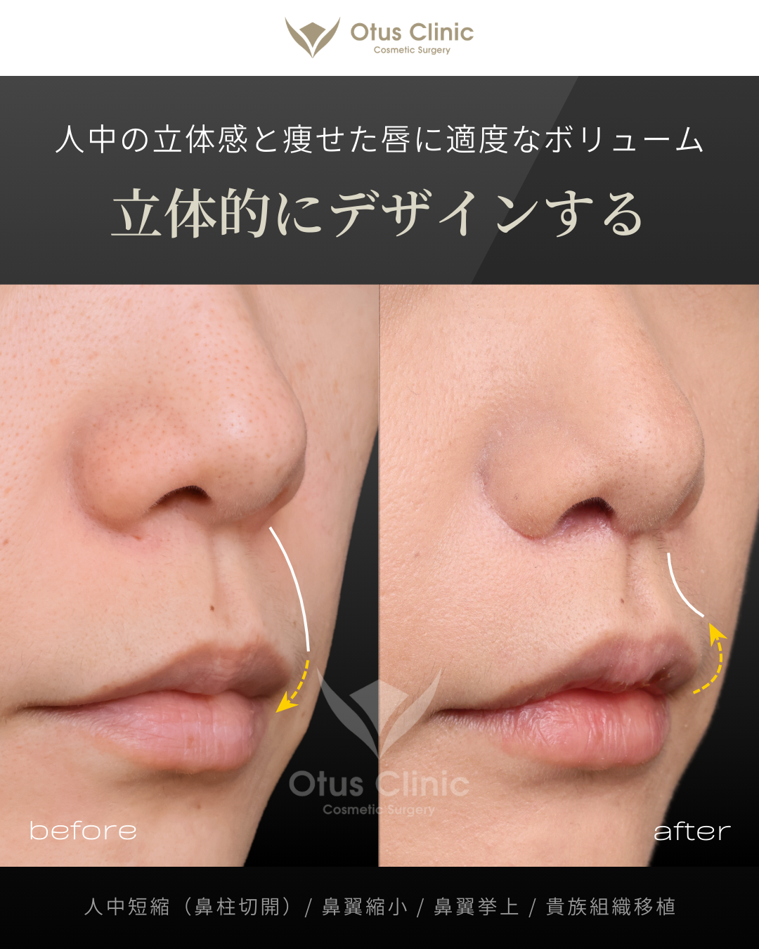 鼻柱切開人中短縮・鼻翼縮小・鼻翼挙上・貴族組織移植