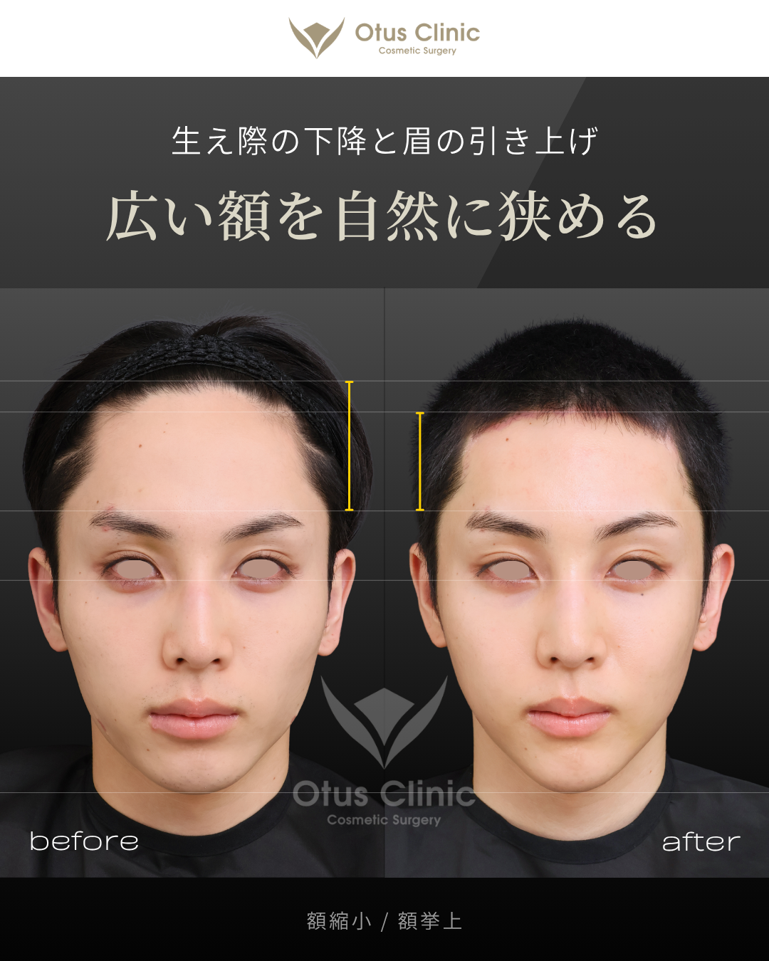 額縮小・額挙上