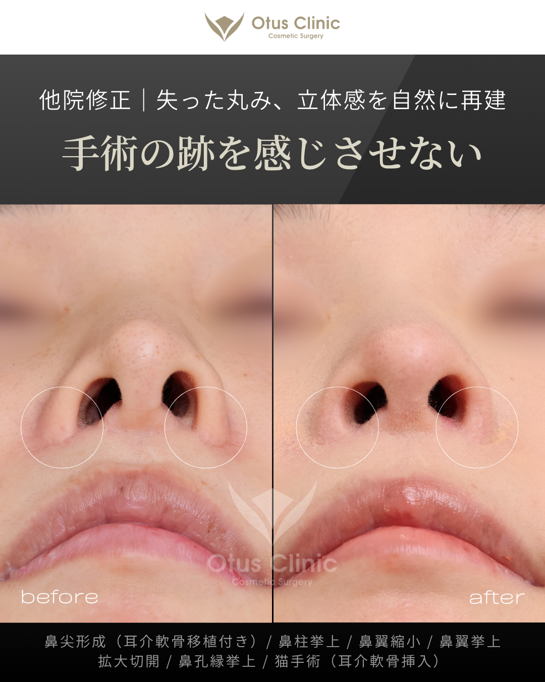 鼻尖形成（耳介軟骨移植付き）・鼻柱挙上・鼻翼縮小・鼻翼挙上・拡大切開・鼻孔縁挙上・猫手術（耳介軟骨挿入）