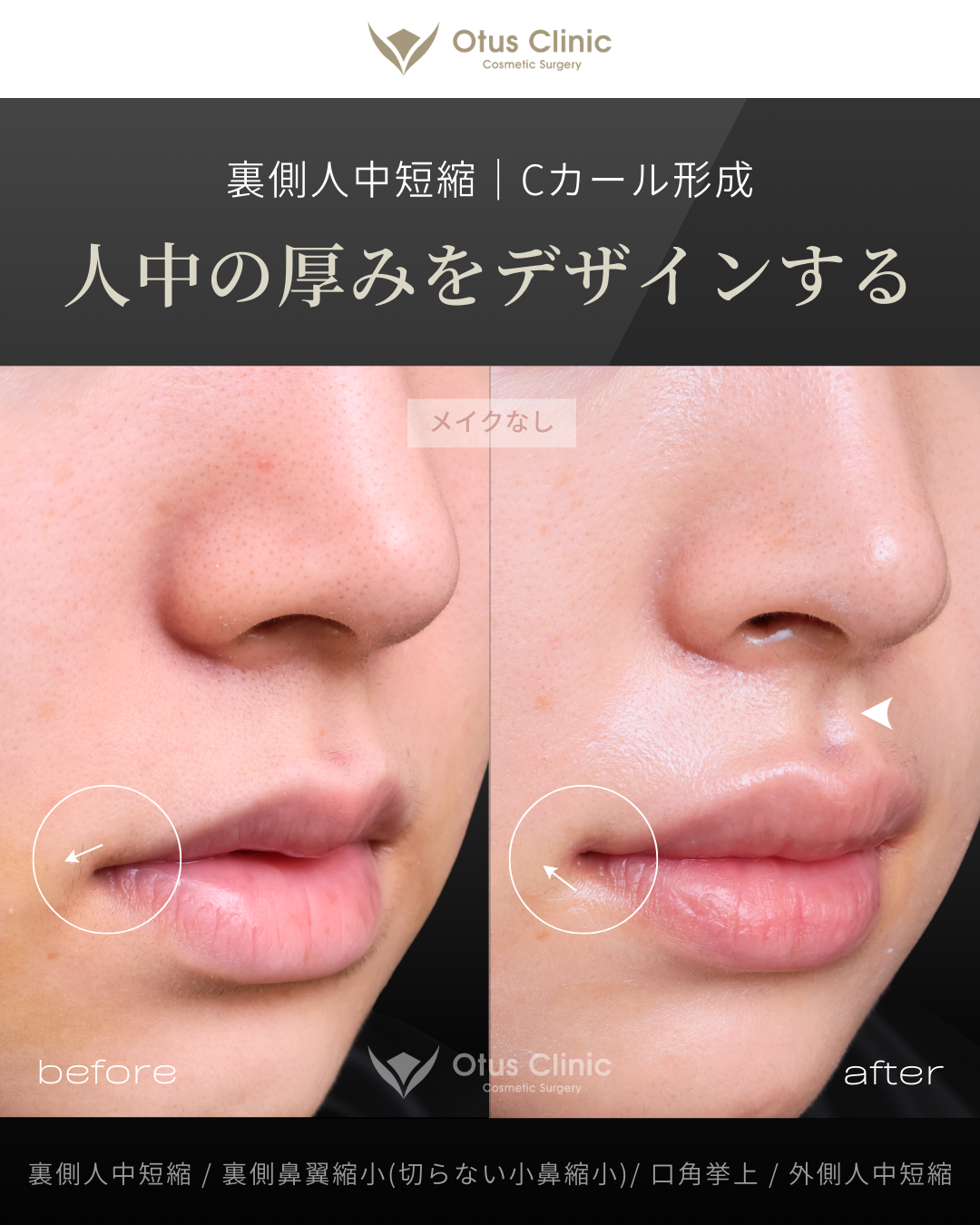 裏側人中短縮・裏側鼻翼縮小(切らない鼻翼縮小)・口角挙上・外側人中短縮