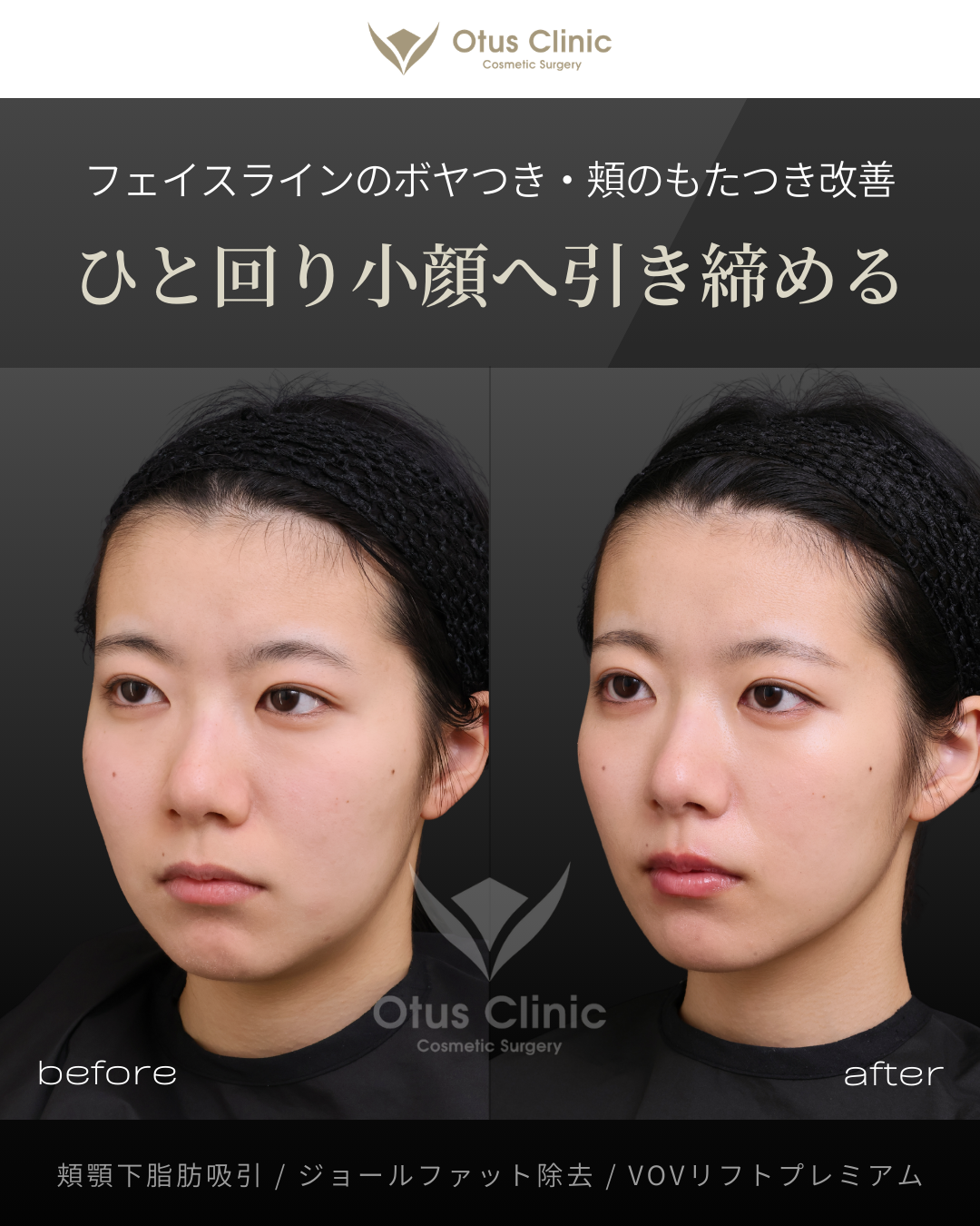 頬顎下脂肪吸引・ジョールファット除去・VOVリフトプレミアム