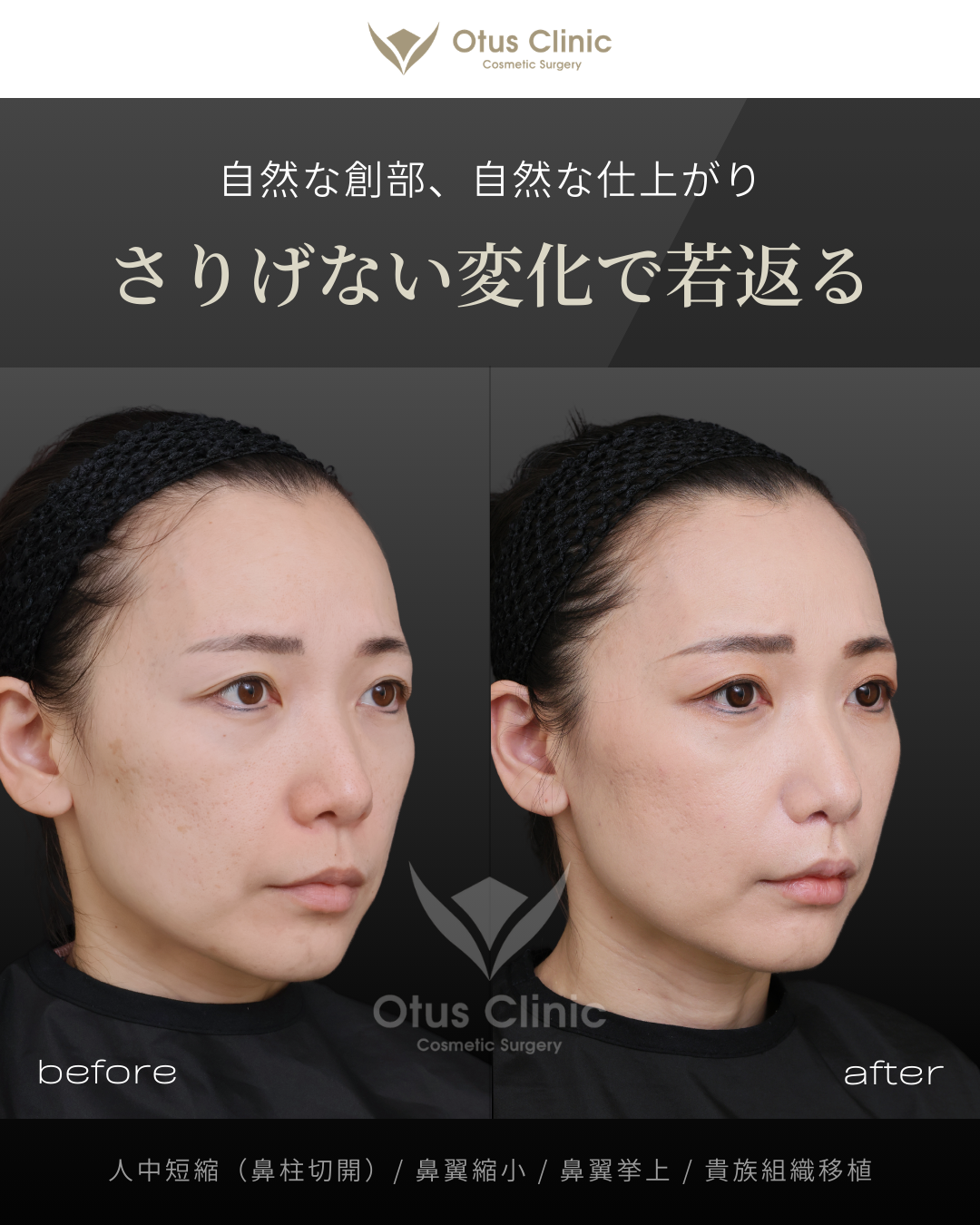 鼻柱切開人中短縮・鼻翼縮小・鼻翼挙上・貴族組織移植