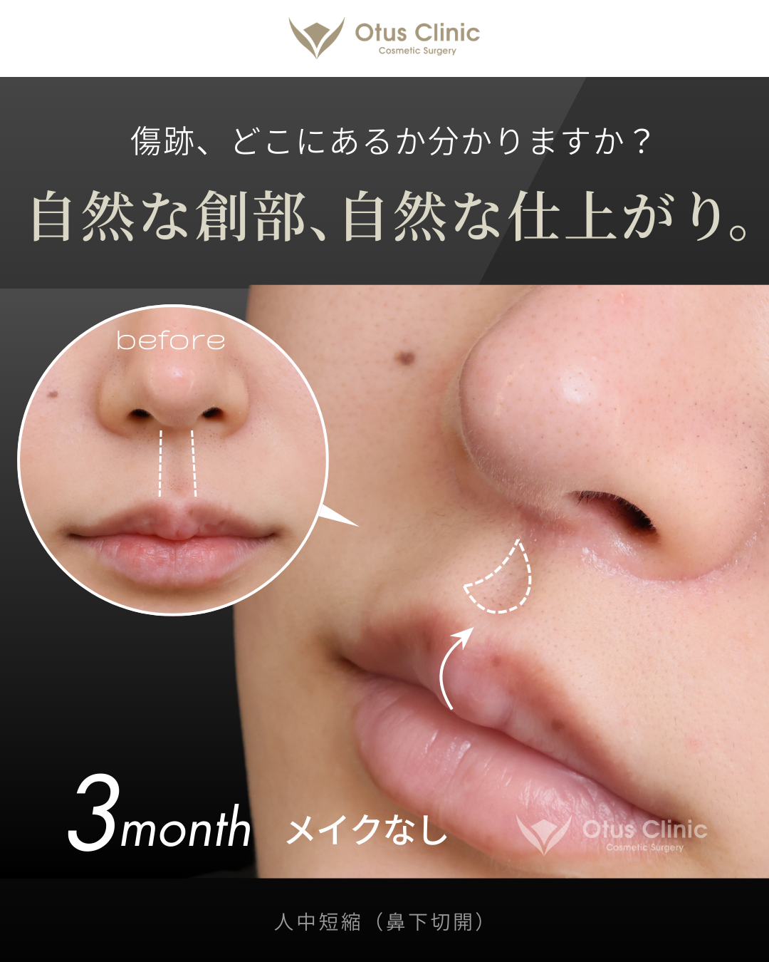 人中短縮(鼻下切開)