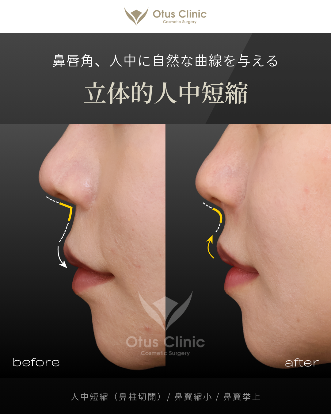 鼻柱切開人中短縮・鼻翼縮小・鼻翼挙上