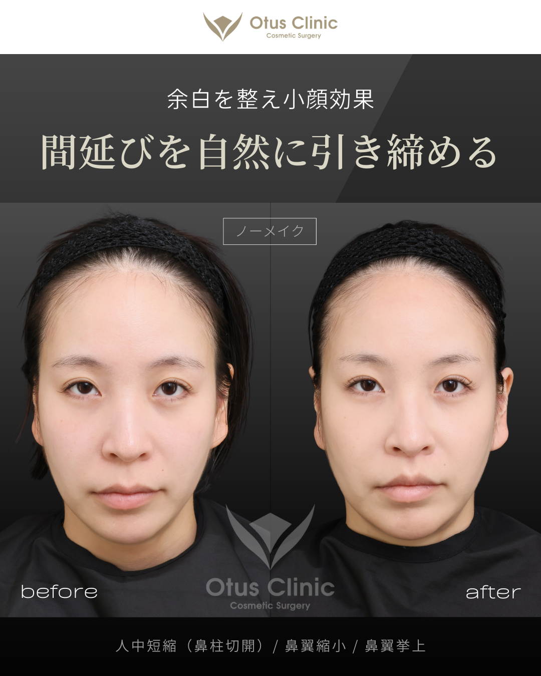 鼻柱切開人中短縮・鼻翼縮小・鼻翼挙上