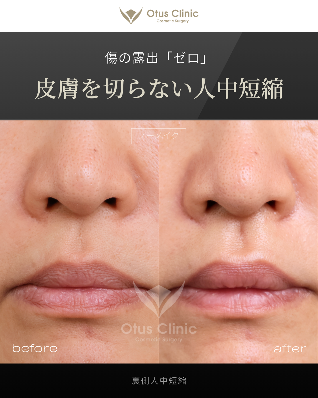 裏側人中短縮（切らない人中短縮）