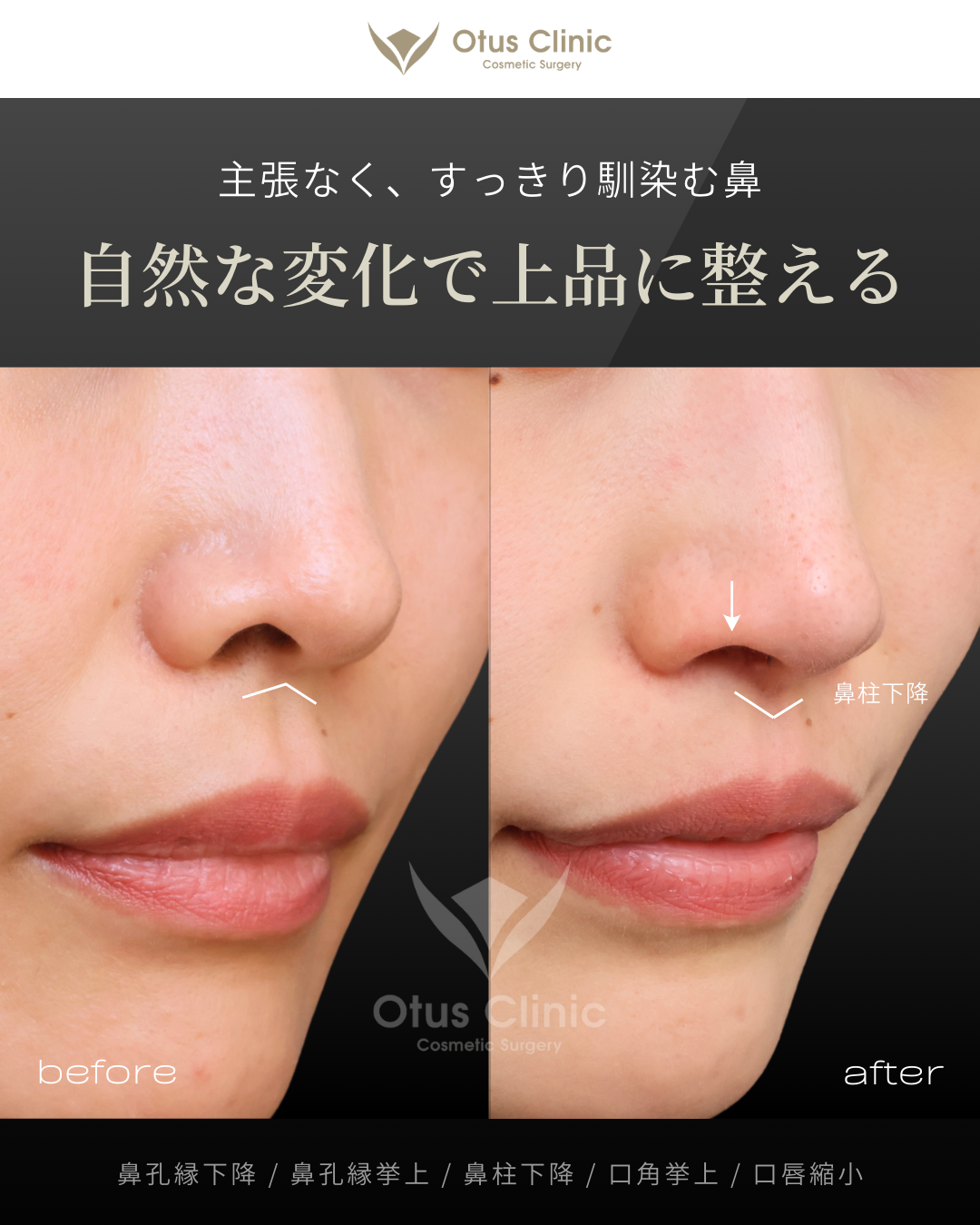 鼻孔縁下降・鼻孔縁挙上・鼻柱下降・口角挙上・口唇縮小