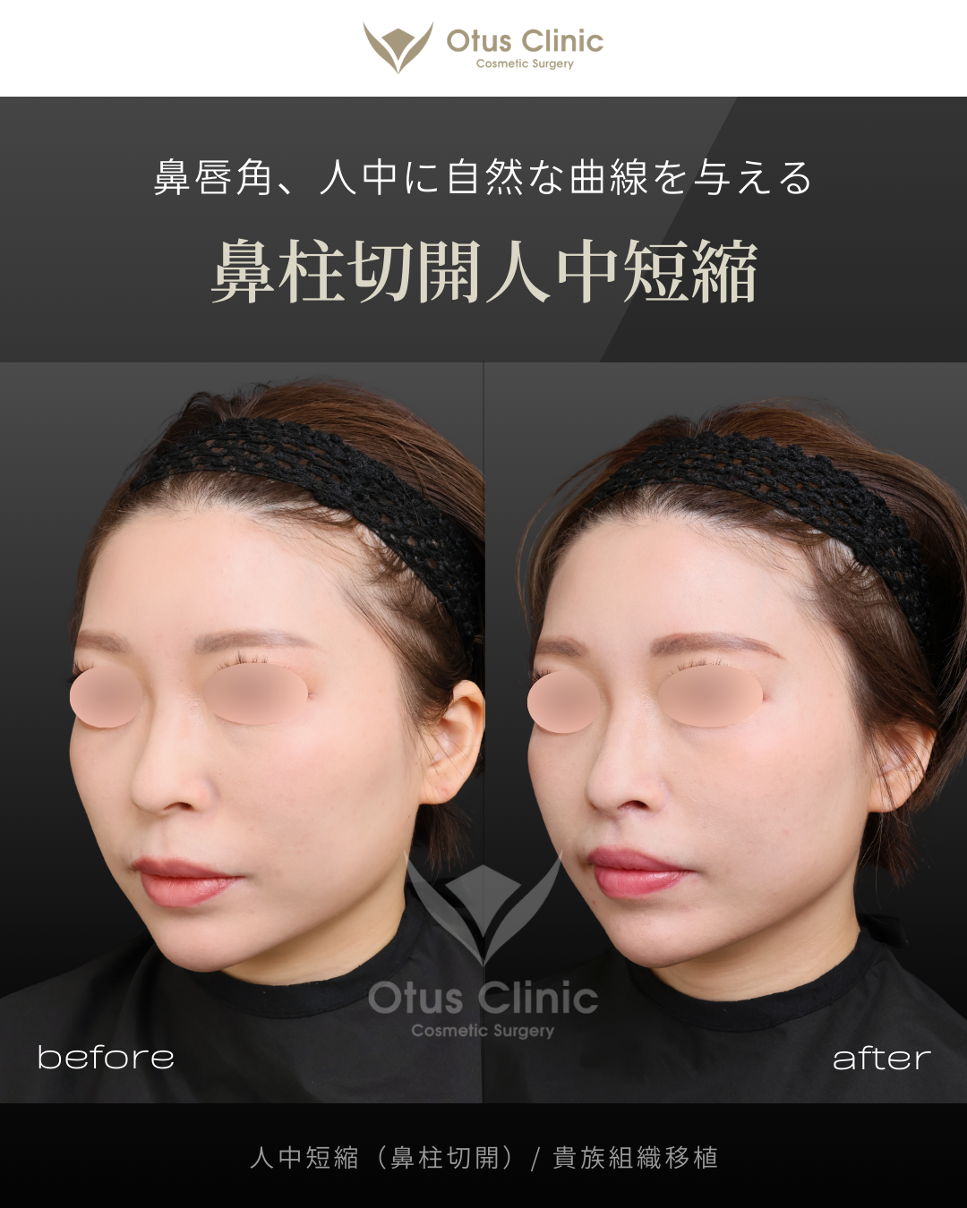 鼻柱切開人中短縮・貴族組織移植