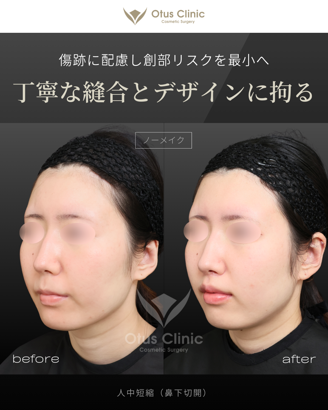 人中短縮（鼻下切開）