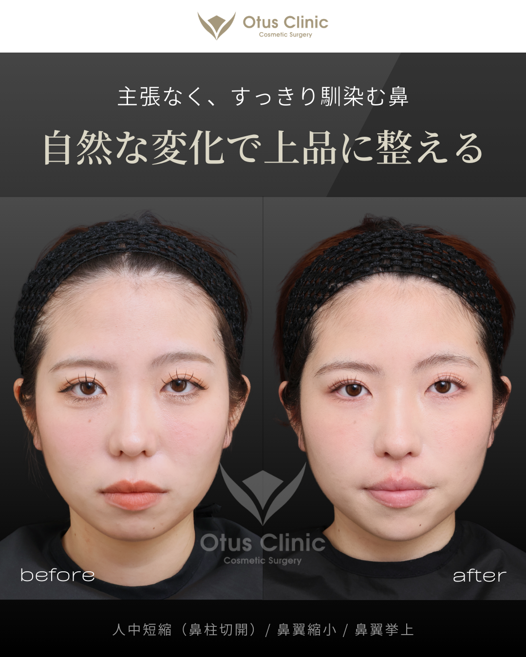 鼻柱切開人中短縮・鼻翼縮小・鼻翼挙上