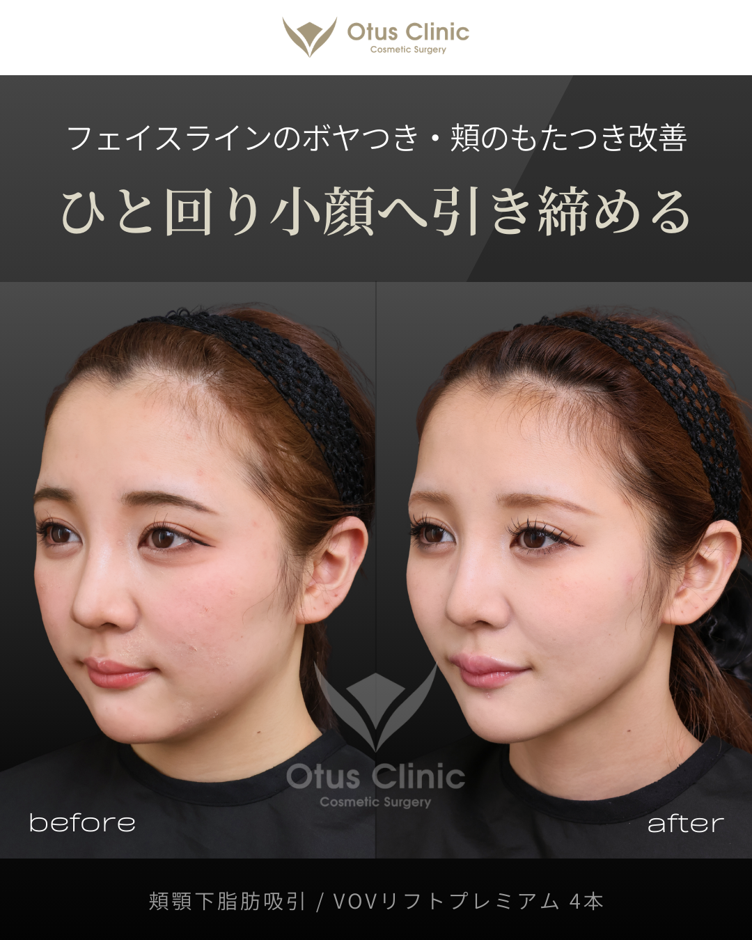 頬顎下脂肪吸引・VOVリフトプレミアム４本