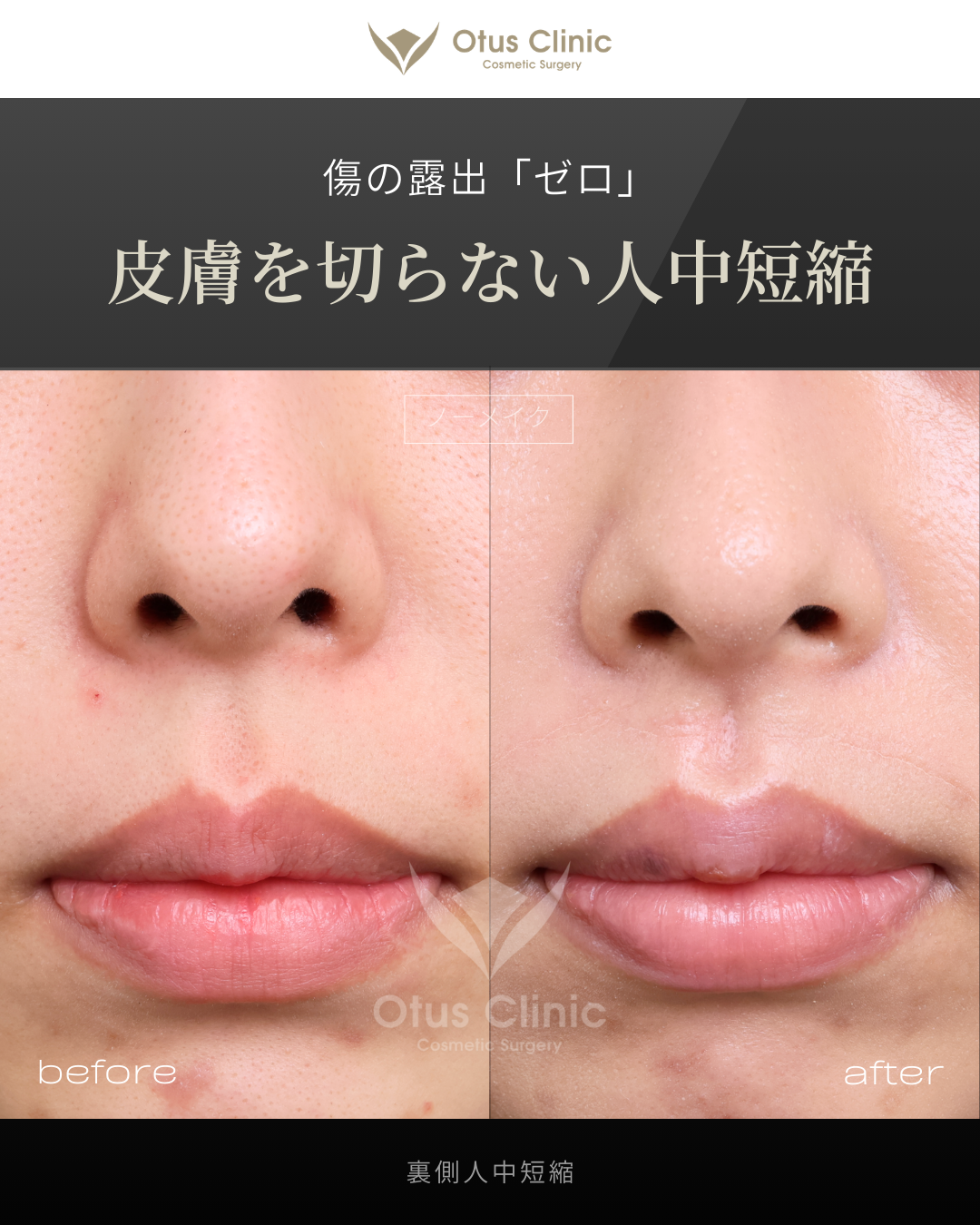 裏側人中短縮（切らない人中短縮）