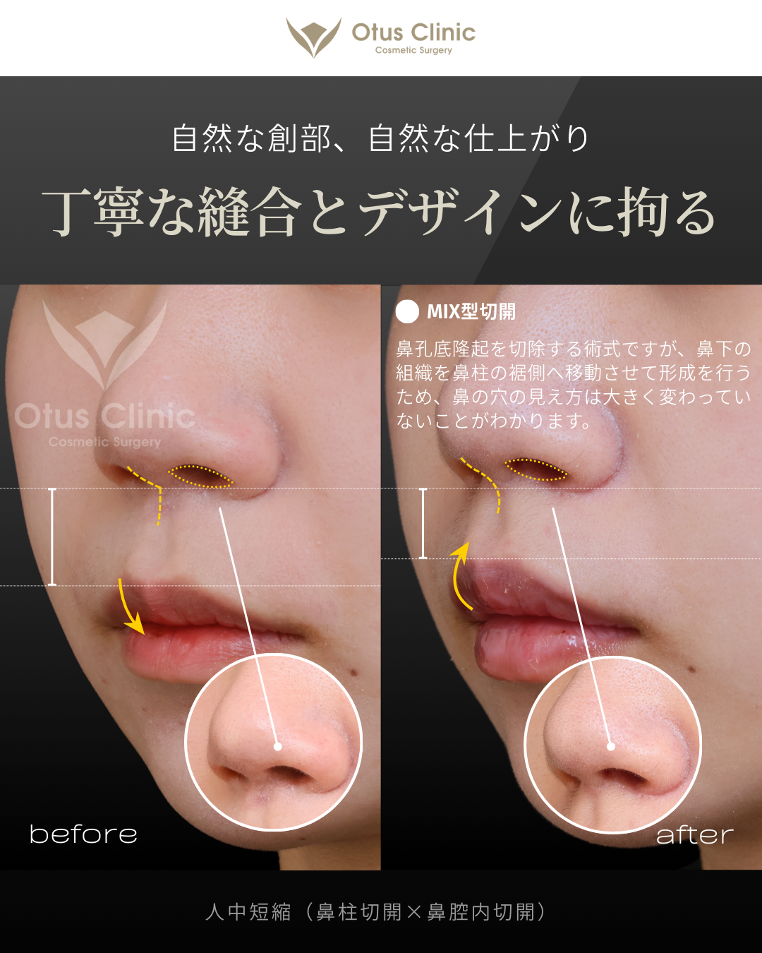 人中短縮(鼻柱切開×鼻腔内切開)
