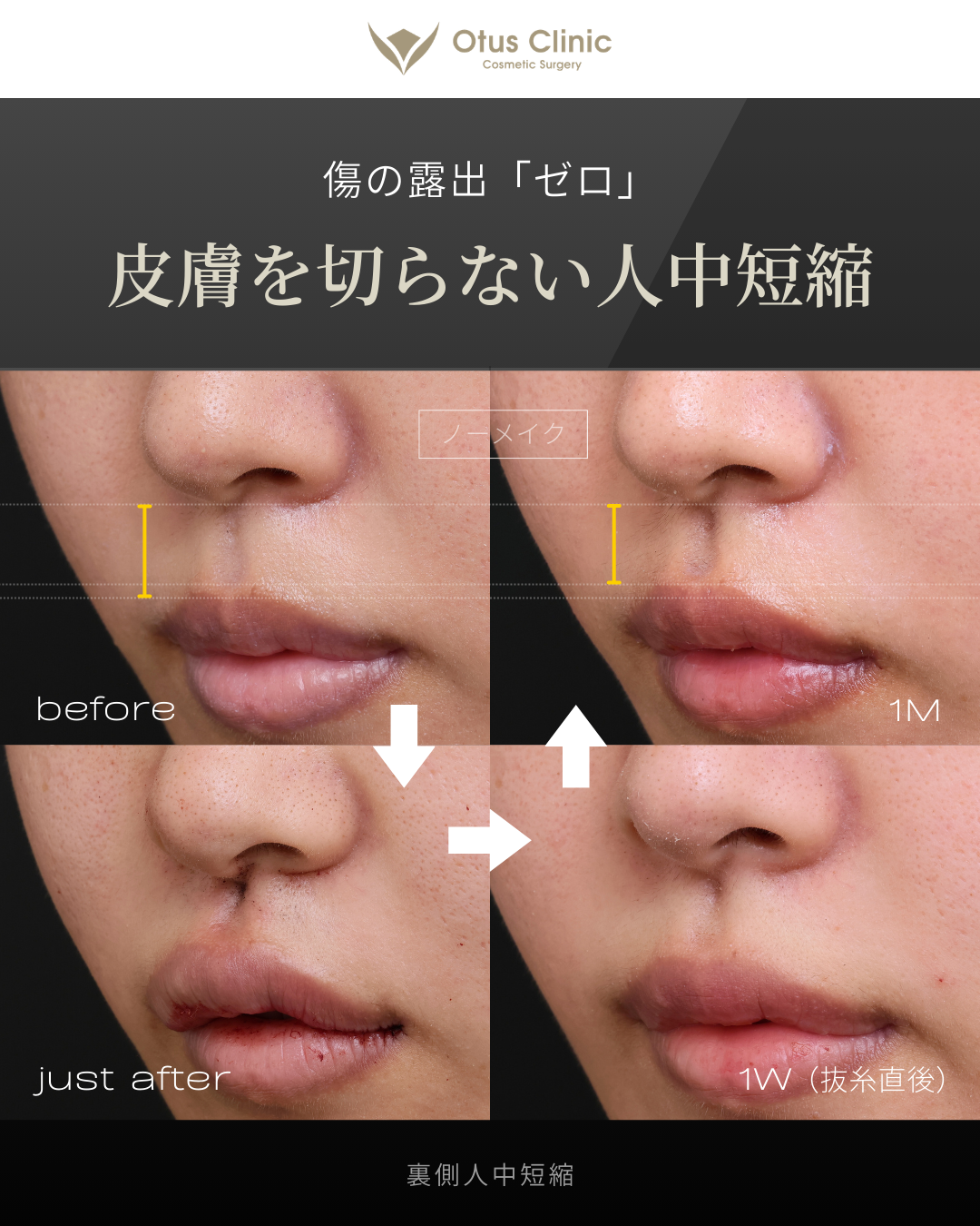 裏側人中短縮（切らない人中短縮）