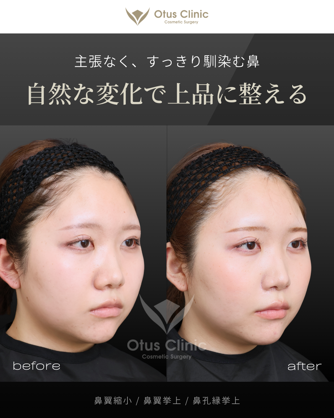 鼻翼縮小・鼻翼挙上・鼻孔縁挙上