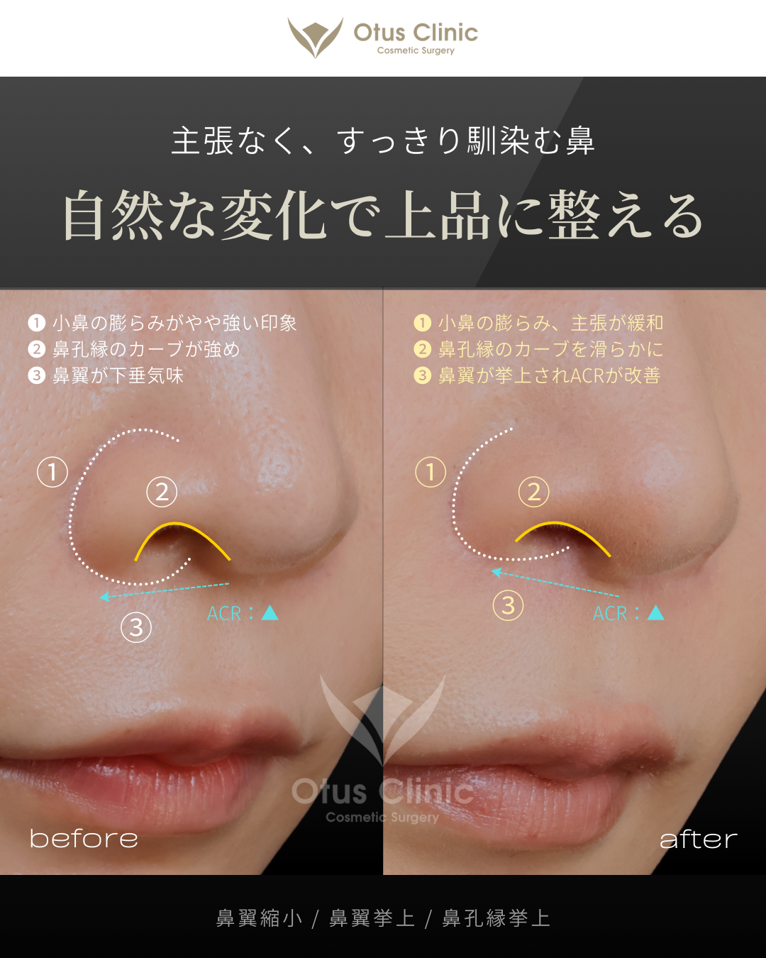 鼻翼縮小・鼻翼挙上・鼻孔縁挙上
