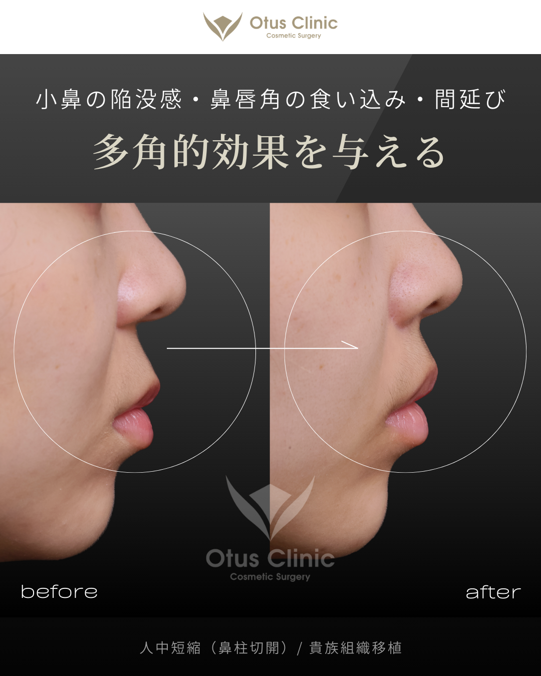 鼻柱切開人中短縮・貴族組織移植