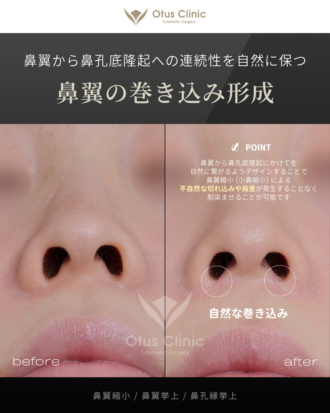 鼻翼縮小・鼻翼挙上・鼻孔縁挙上