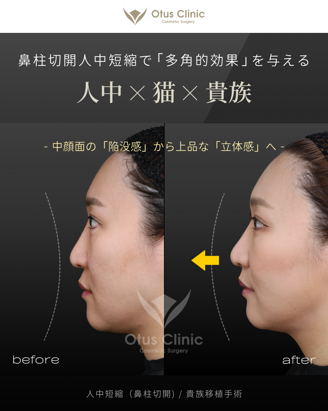 鼻柱切開人中短縮・ 貴族組織移植