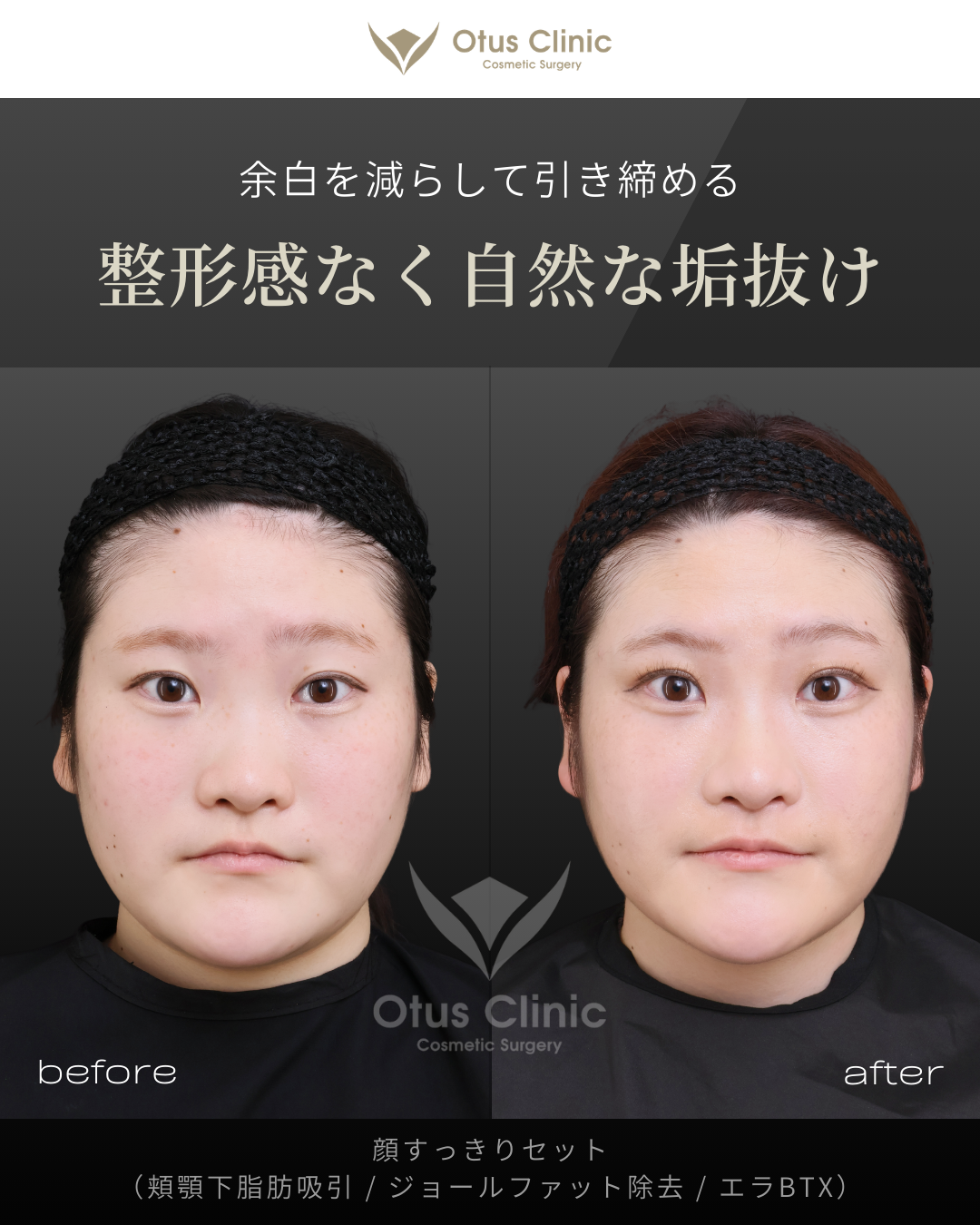 頬顎下脂肪吸引 ・ジョールファット除去 ・ エラBTX