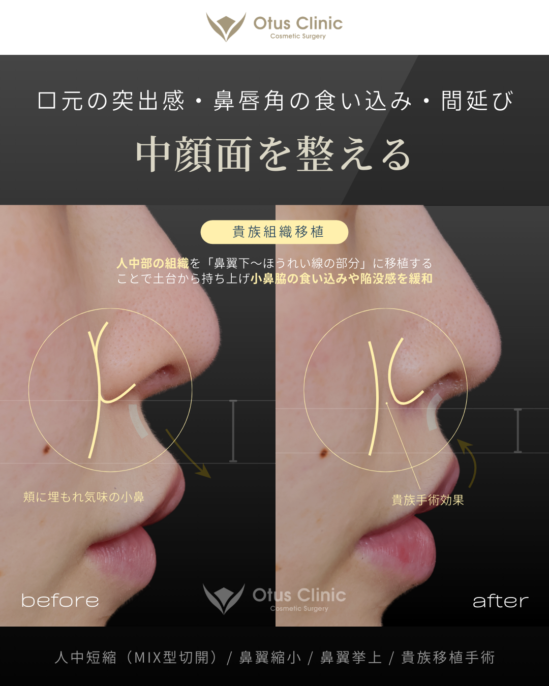 人中短縮(鼻柱切開×鼻腔内切開)・鼻翼縮小・鼻翼挙上・貴族組織移植