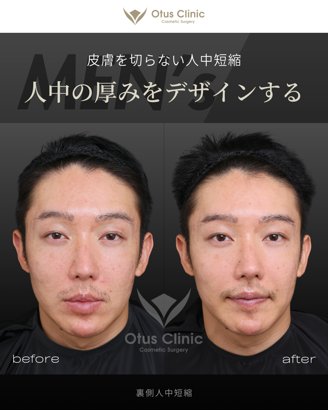 裏側人中短縮（切らない人中短縮）