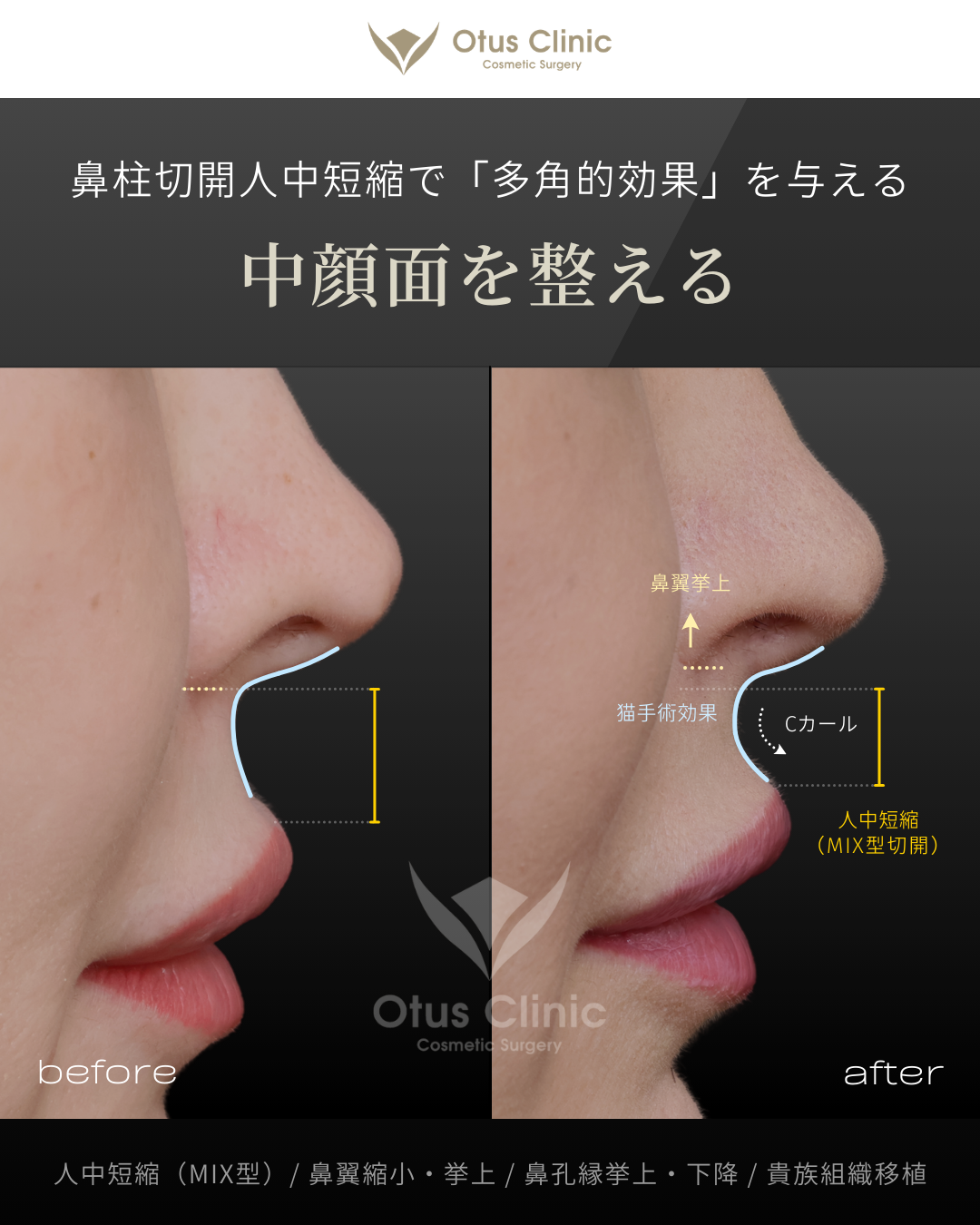 人中短縮（鼻柱切開×鼻腔内切開）・鼻翼縮小・鼻翼挙上・鼻孔縁挙上・鼻孔縁下降・貴族組織移植