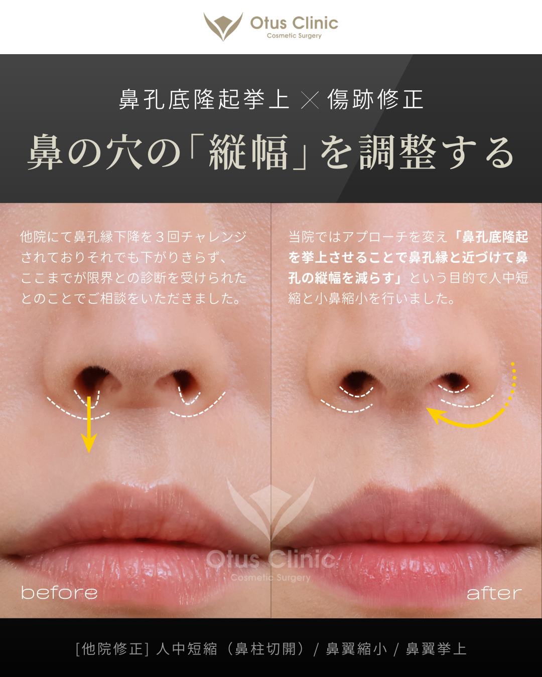 【他院修正】鼻柱切開人中短縮・鼻翼縮小・鼻翼挙上