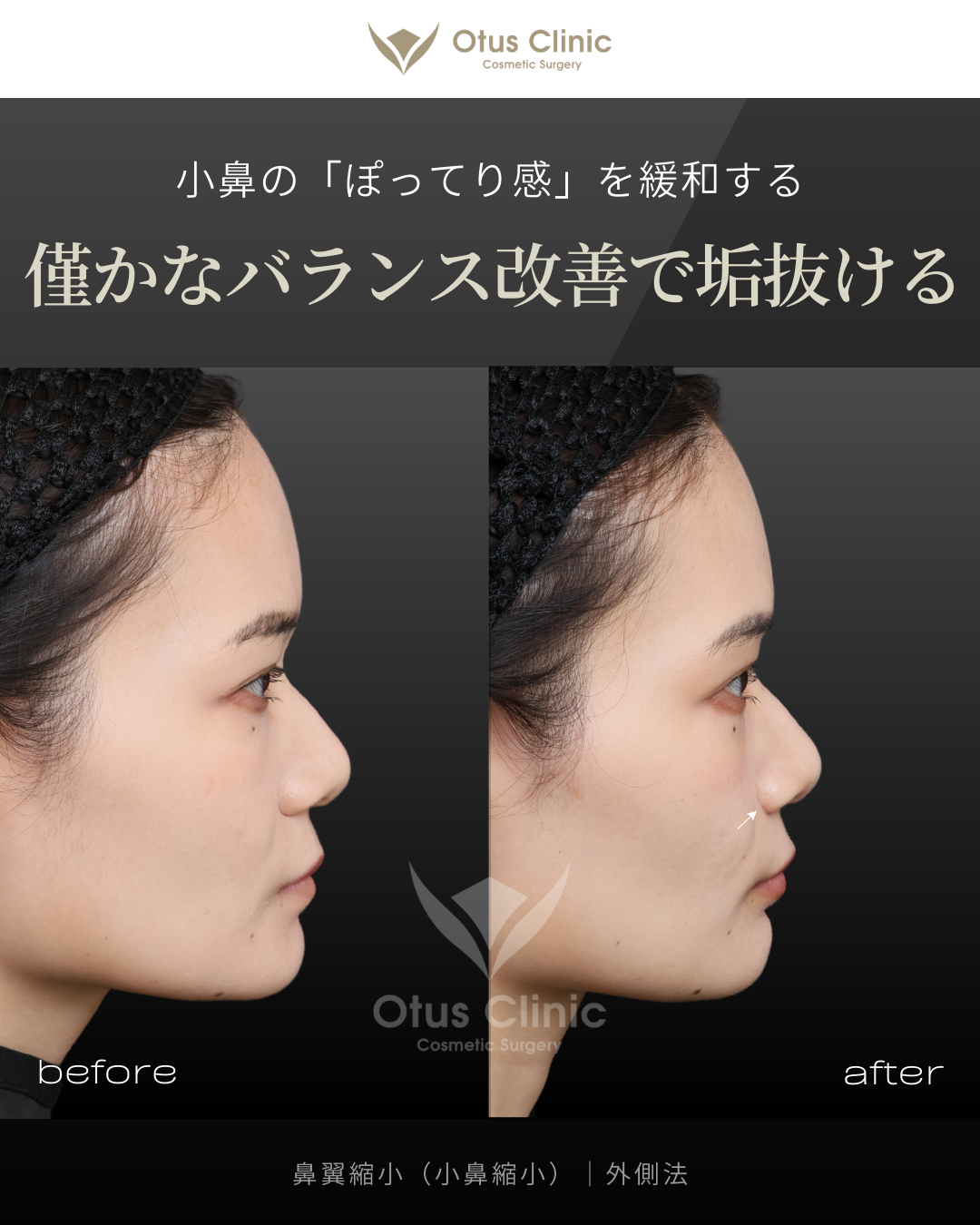 鼻翼縮小（小鼻縮小）｜外側法