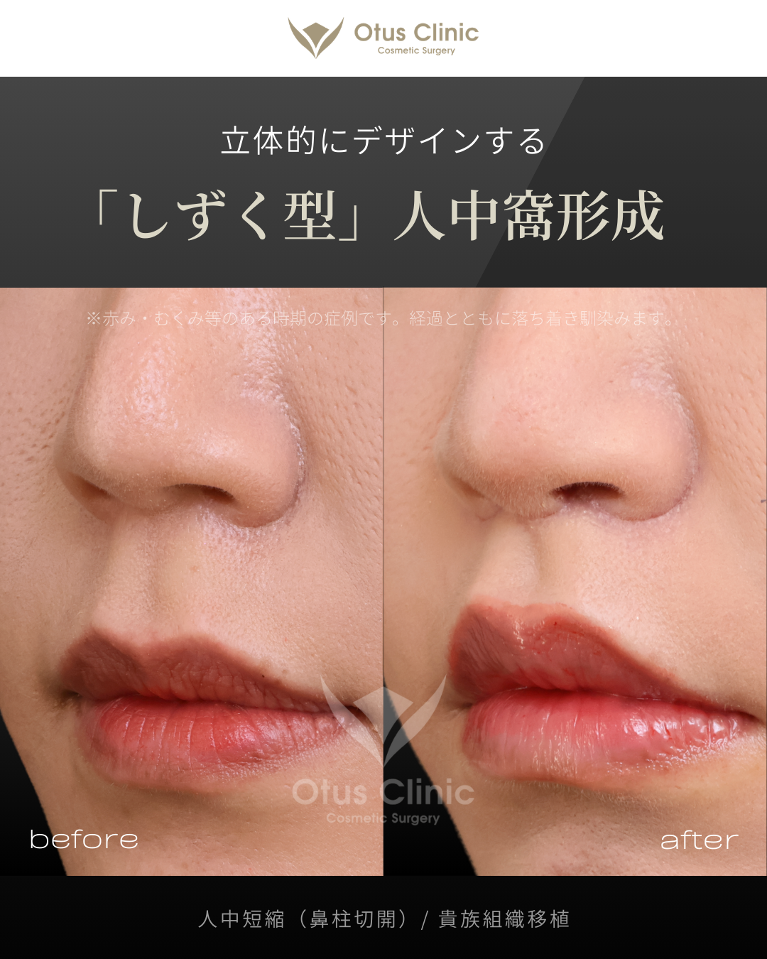 鼻柱切開人中短縮・貴族組織移植