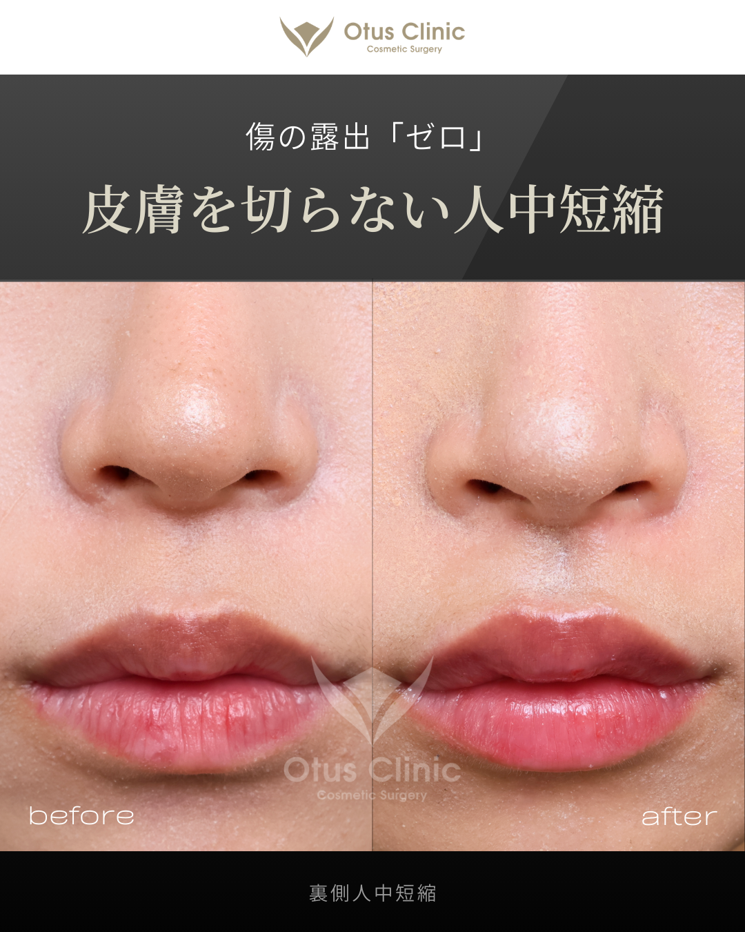 裏側人中短縮（切らない人中短縮）