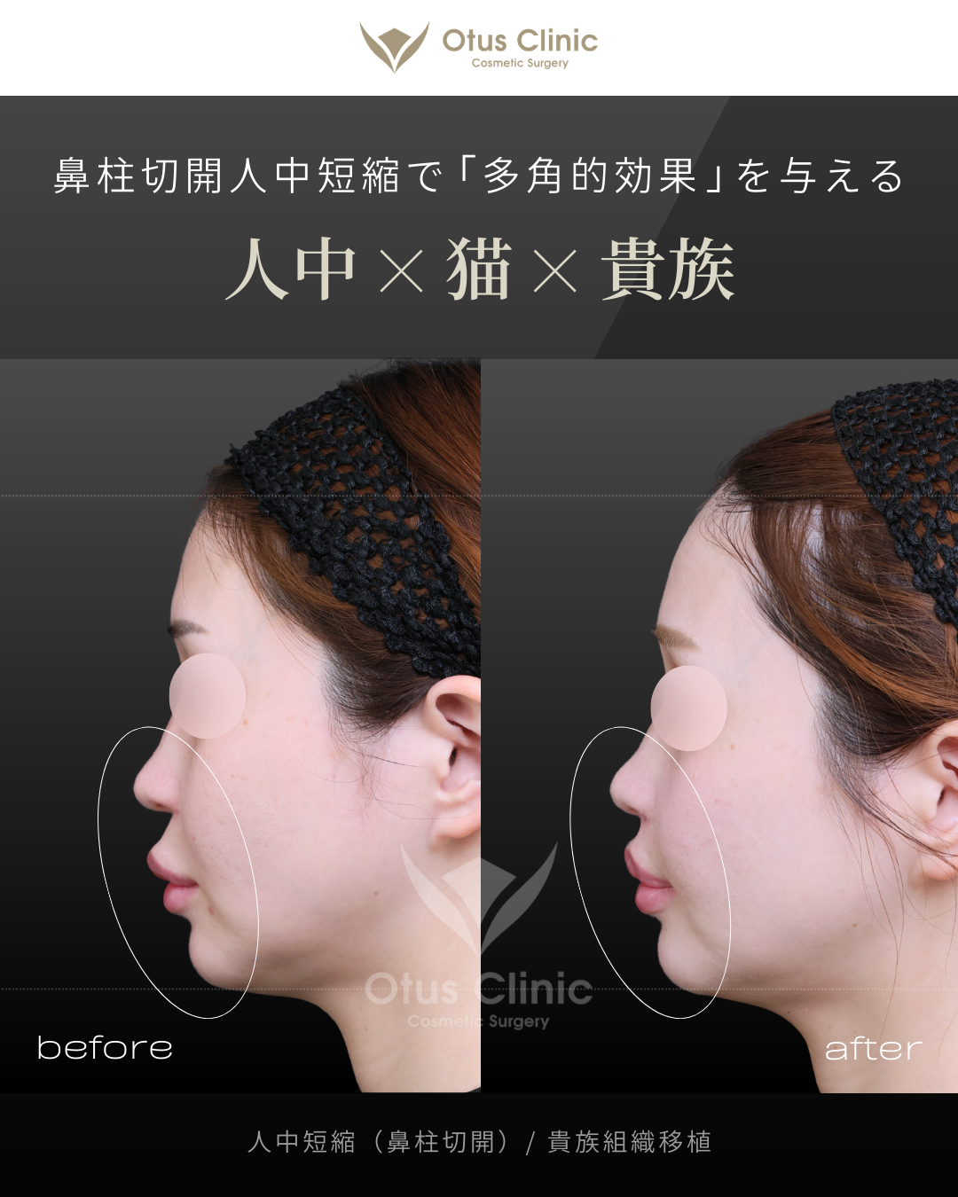 鼻柱切開人中短縮・貴族組織移植