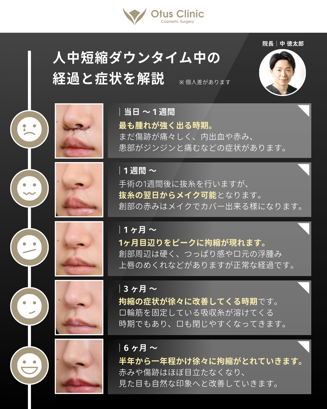 人中短縮（鼻下切開）