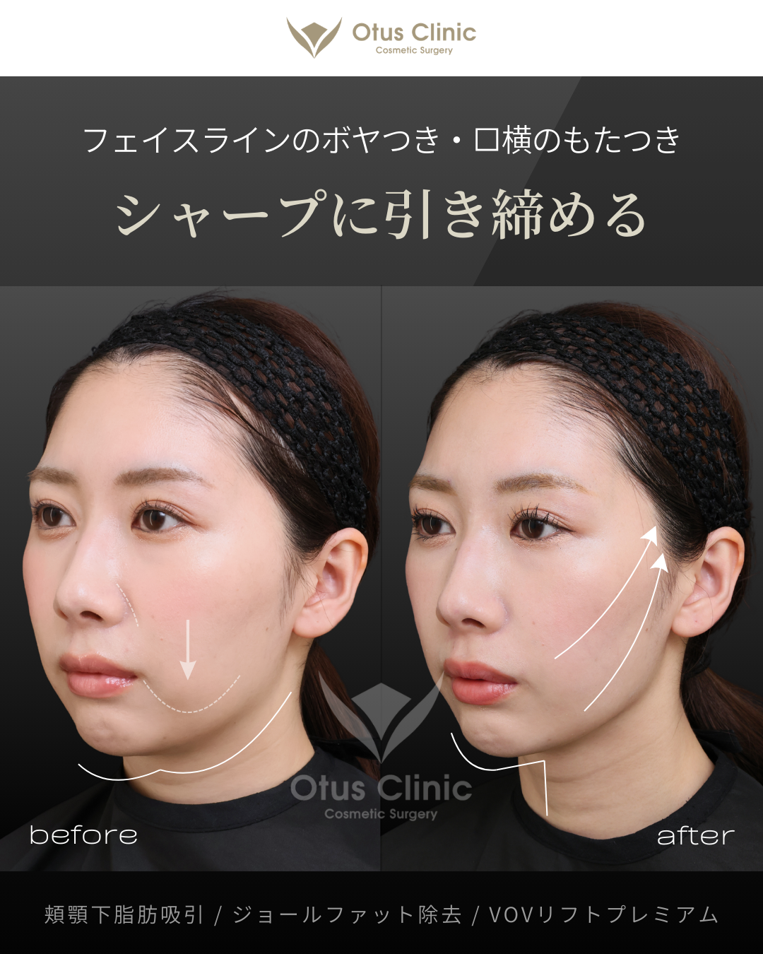 頬顎下脂肪吸引 ・ジョールファット除去 ・VOVリフトプレミアム