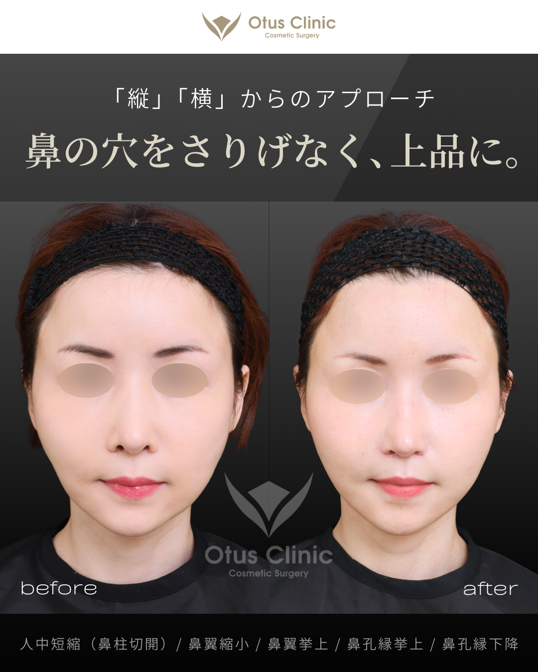 鼻柱切開人中短縮・鼻翼縮小・鼻翼挙上・鼻孔縁挙上・鼻孔縁下降