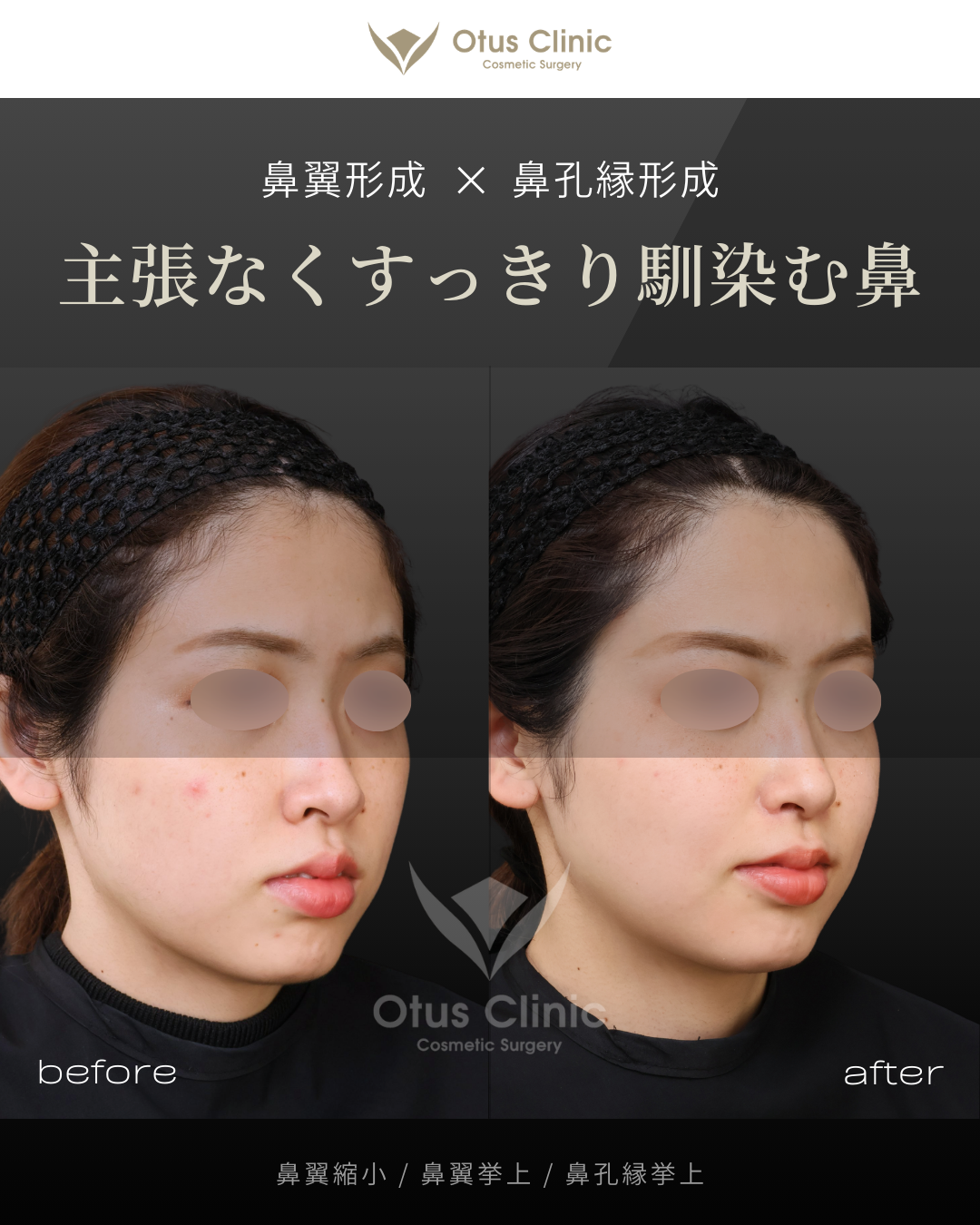 鼻翼縮小・鼻翼挙上・鼻孔縁挙上