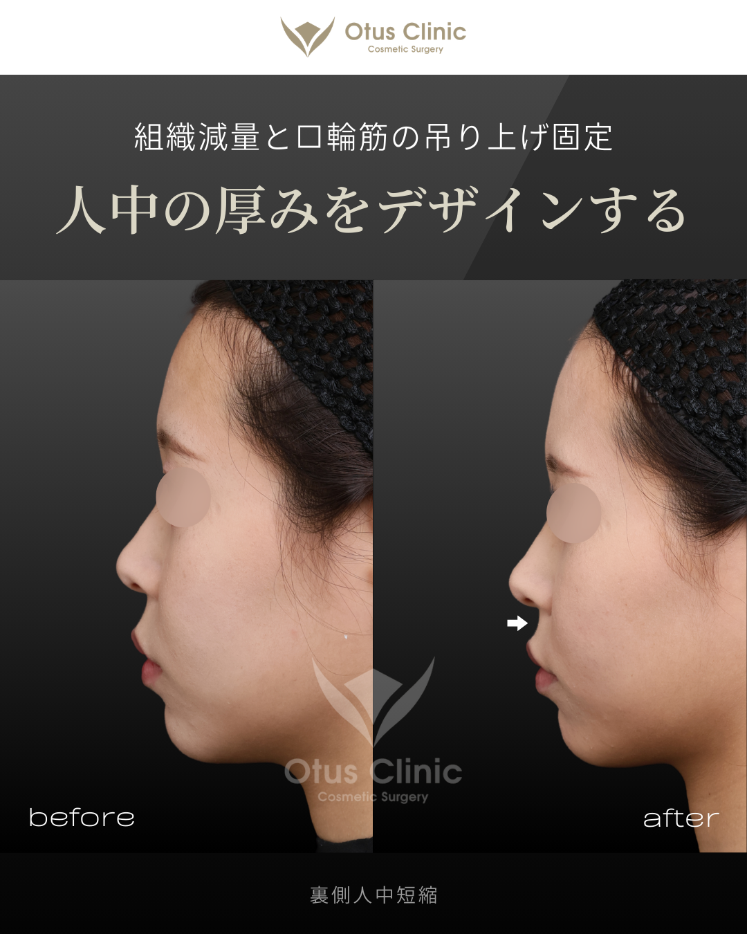 裏側人中短縮（切らない人中短縮）