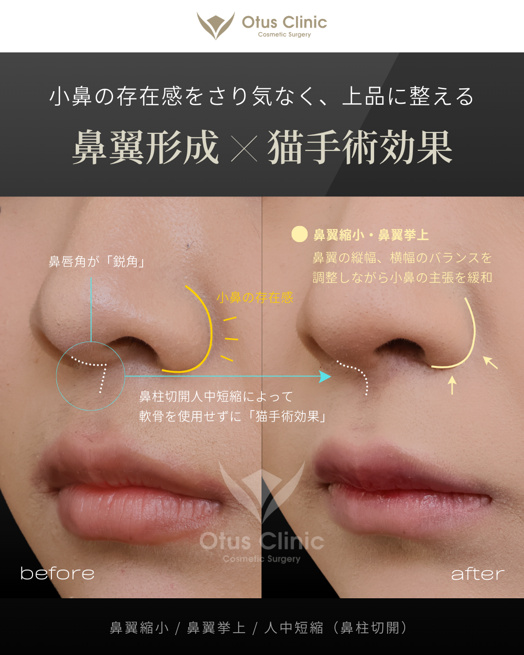 鼻翼縮小・鼻翼挙上・鼻柱切開人中短縮