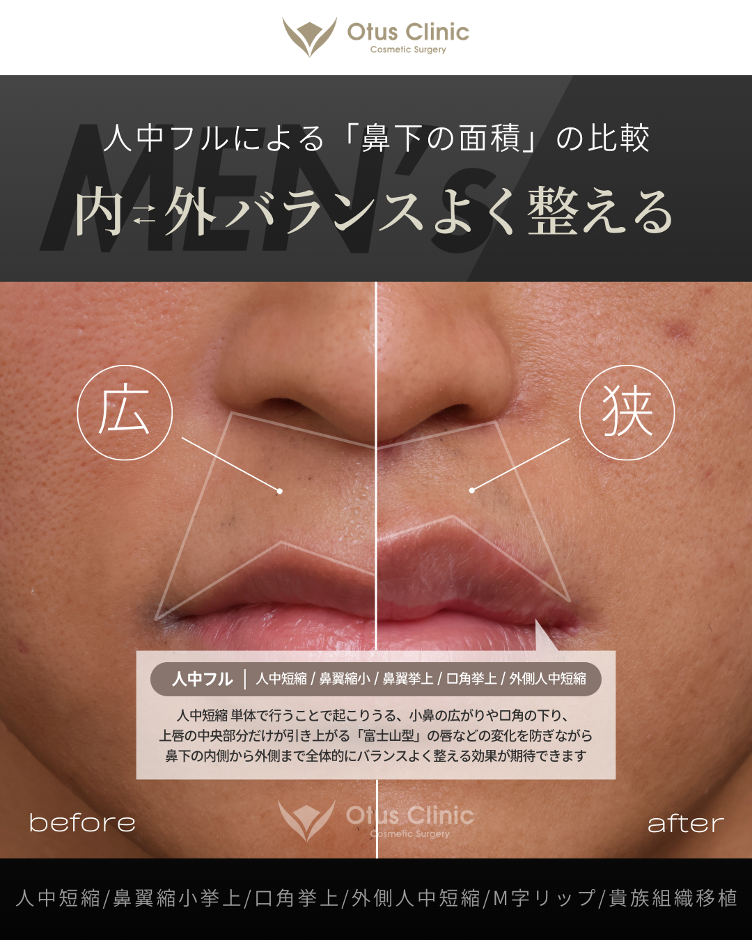 人中フル（人中短縮 / 鼻翼縮小 / 鼻翼挙上 / 外側人中短縮 / 口角挙上）・M字リップ ・貴族組織移植