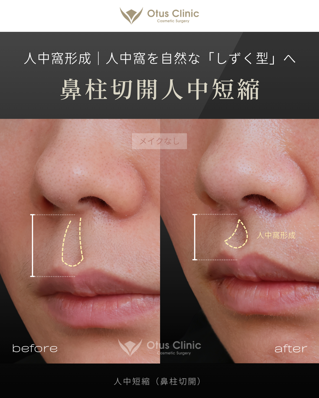 鼻柱切開人中短縮