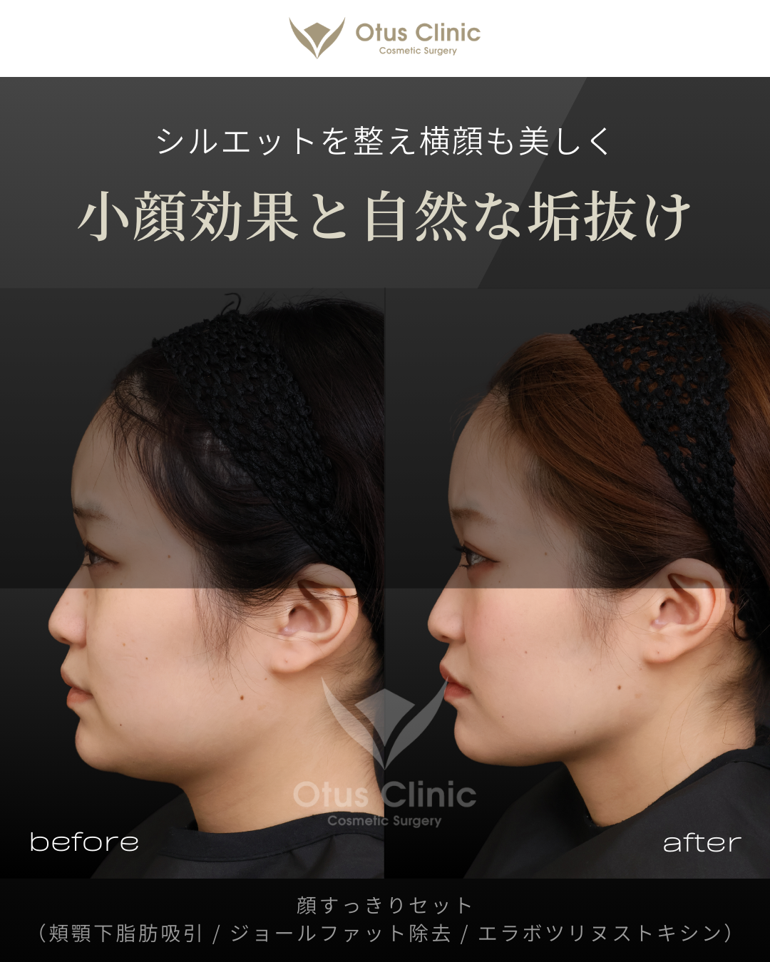 頬顎下脂肪吸引 ・ジョールファット除去 ・ エラBTX